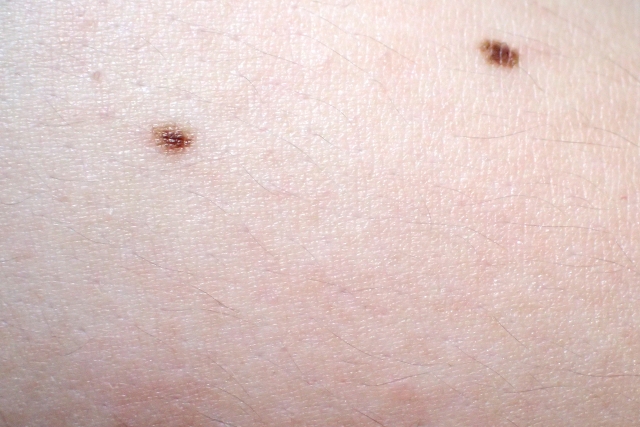 皮膚腫瘍・皮下腫瘍とは?粉瘤も症状の一つ!
