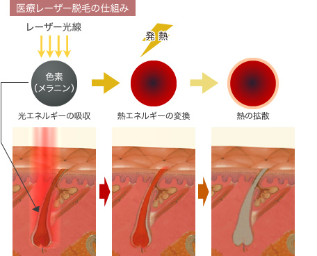 医療レーザー脱毛の仕組み