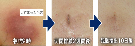 手術症例写真集について 粉瘤 脂肪腫 わきが治療やレーザー脱毛なら 日本橋形成外科 皮フ科 美容外科